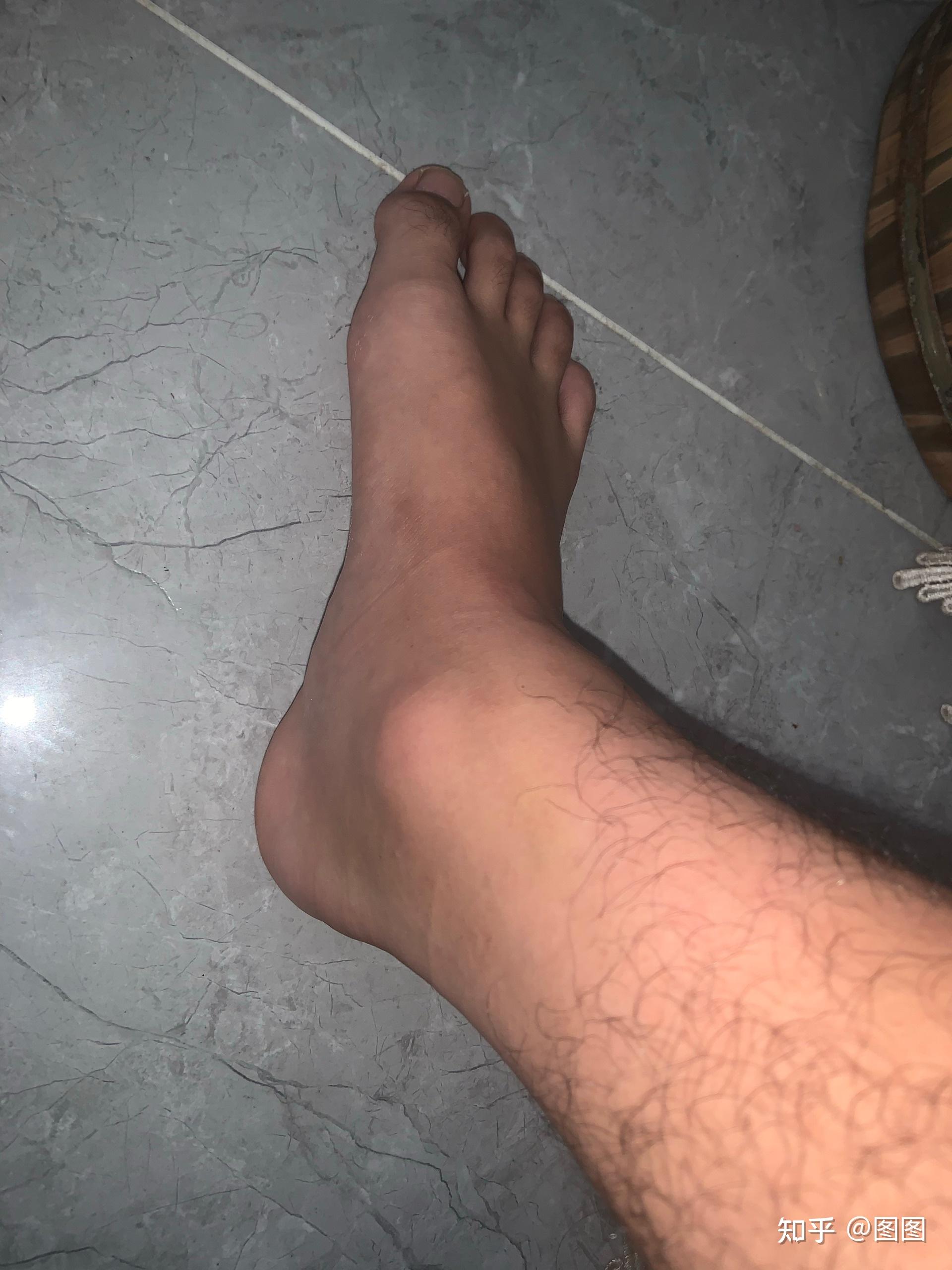 脚崴了之后多久可以好啊