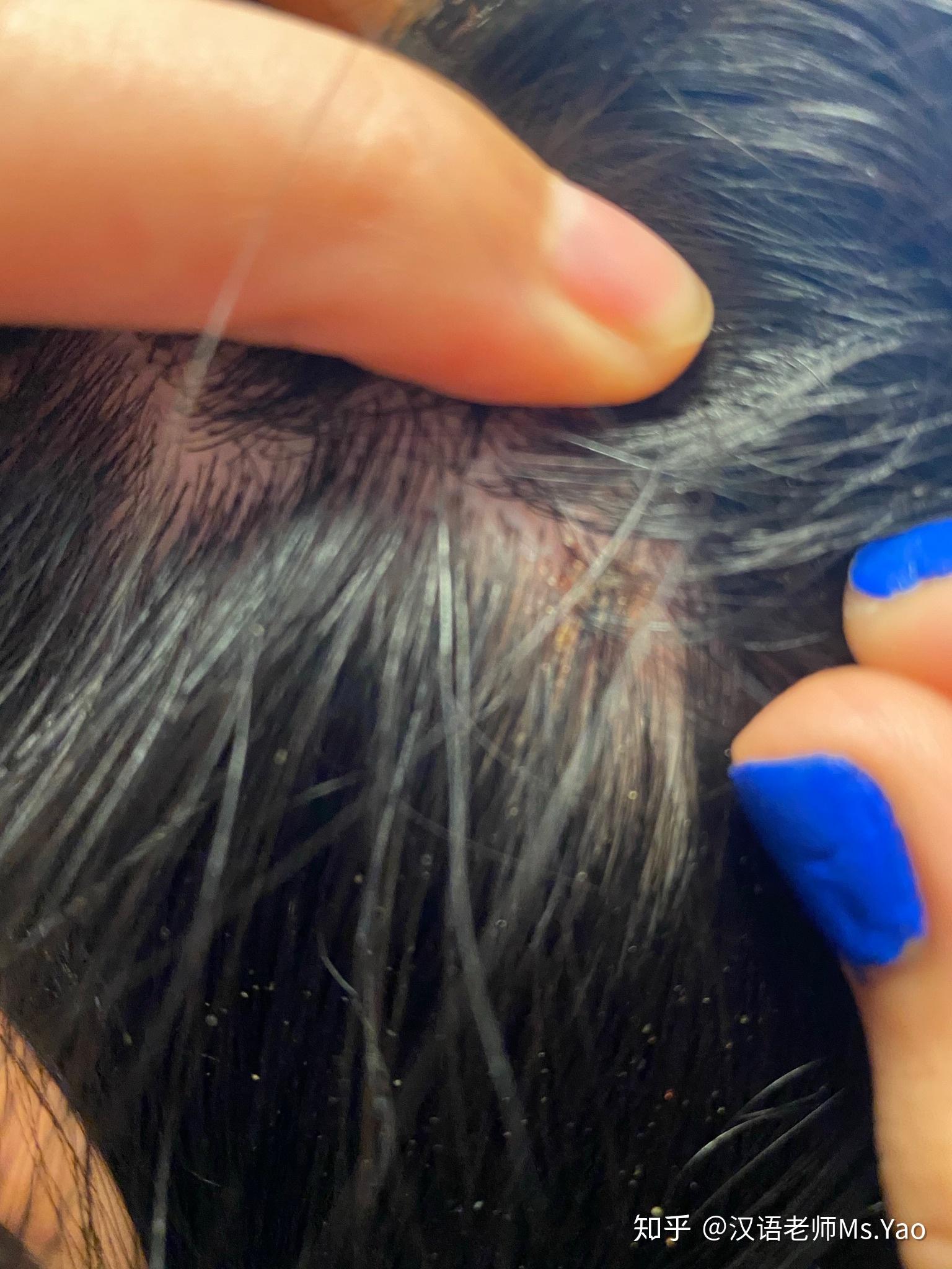 一直挠头头上有许多结痂怎么能不挠这是怎么回事而且挠完扣下结痂会有