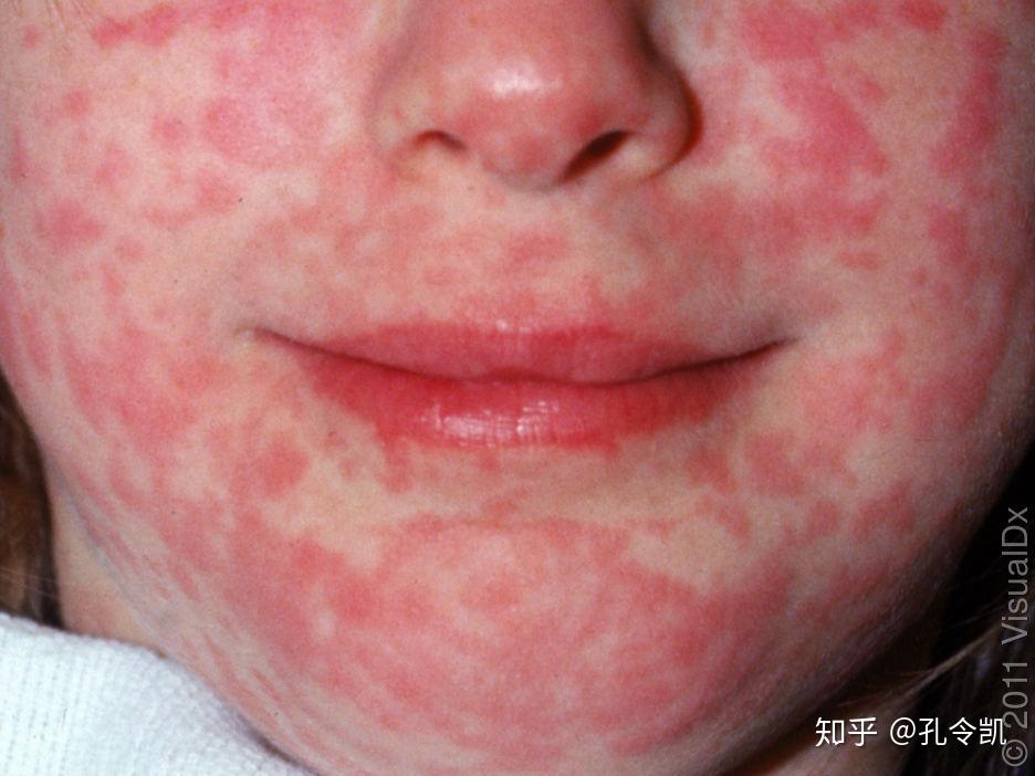 麻疹粘膜斑图片
