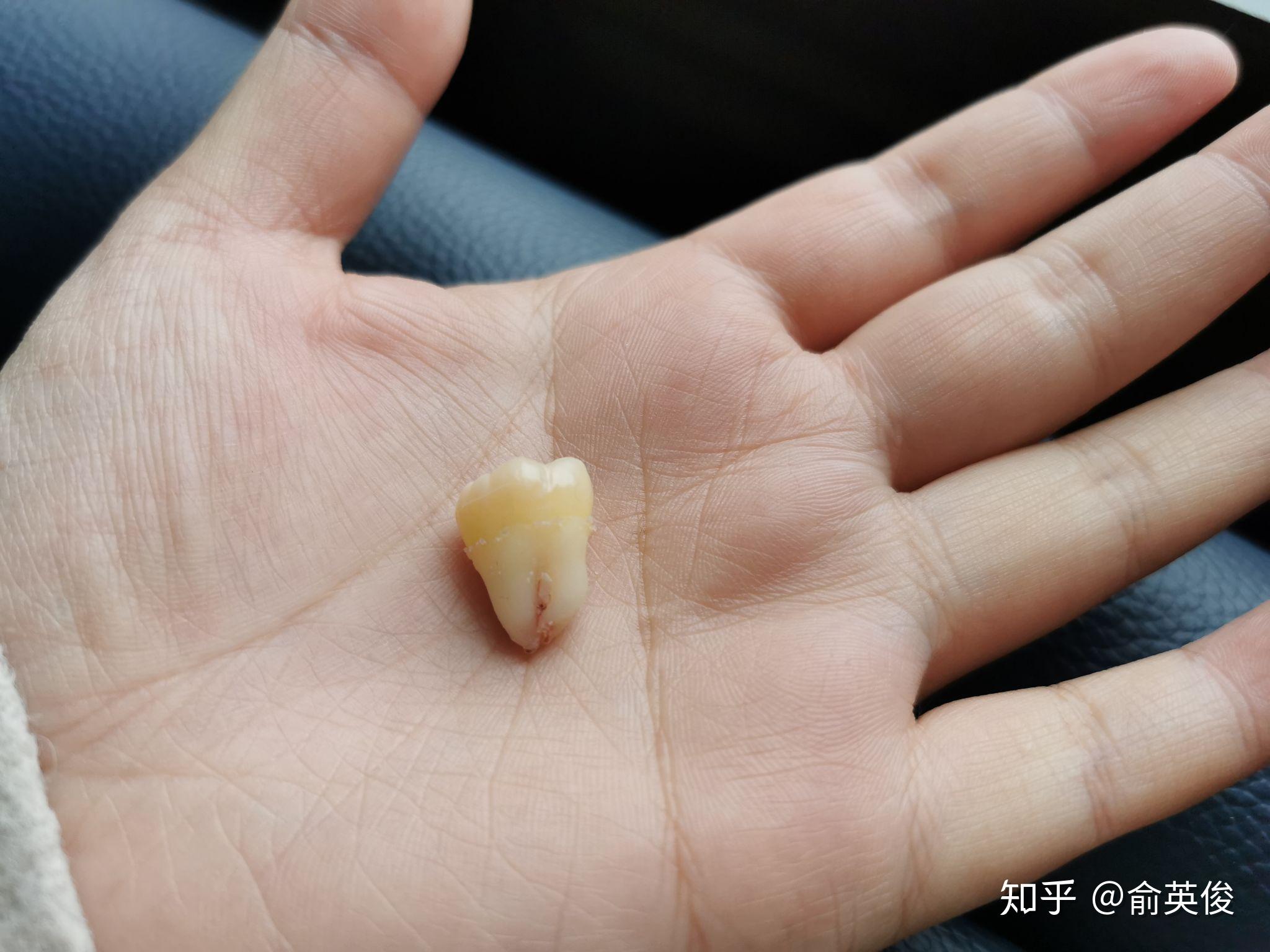 拔智齿是怎么样的一种体验