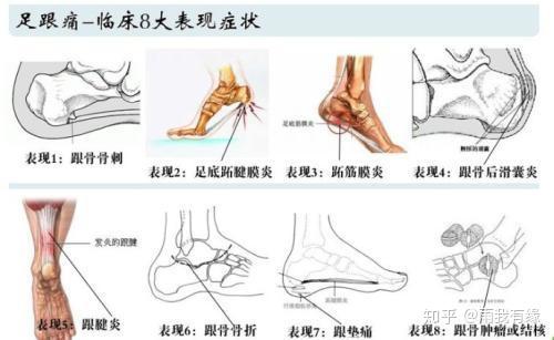 人过40后小心——足跟痛!钻心痛!谁疼谁知道!