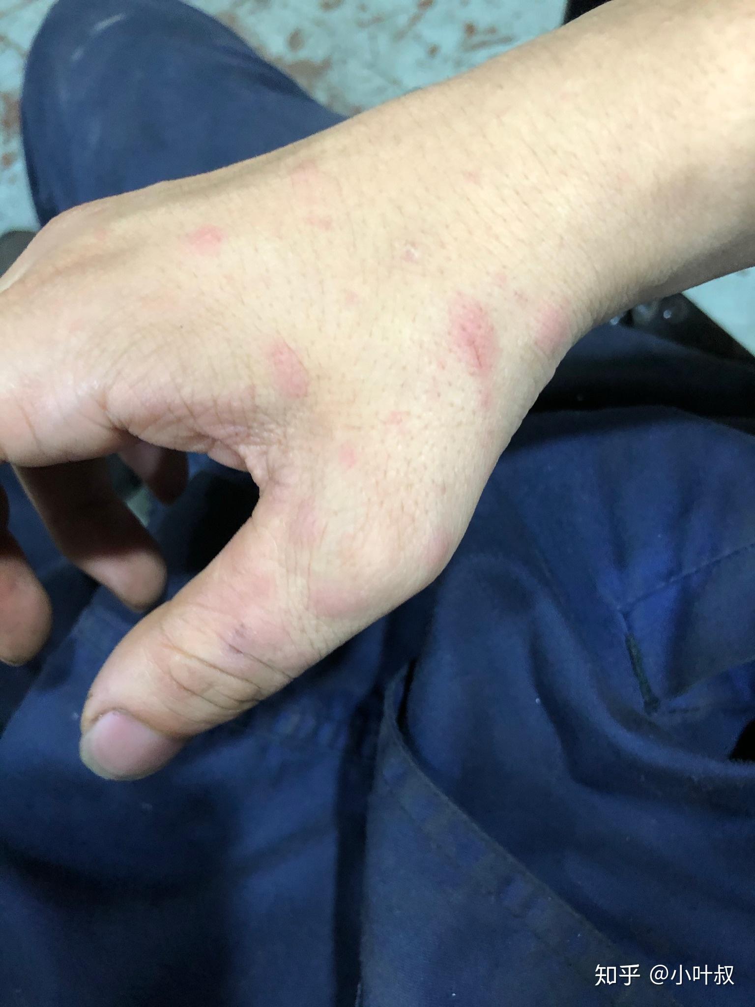 手上出现红斑红疹是什么问题? - 知乎