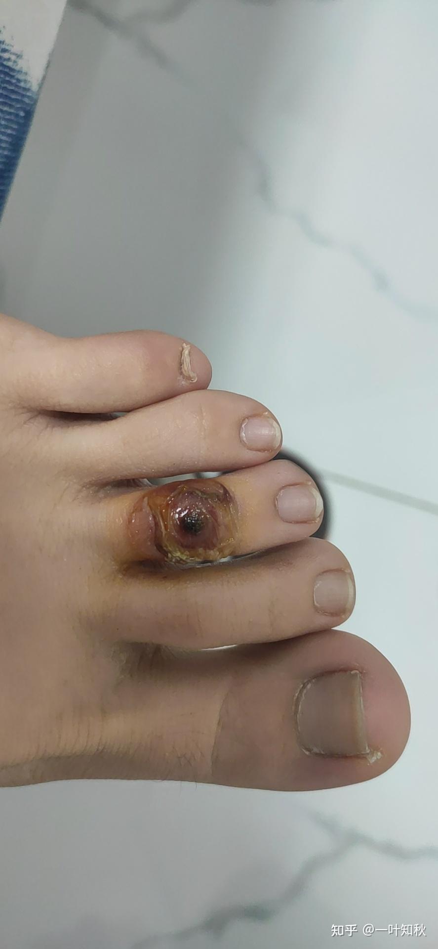 液氮冷冻治疗后手指上出了血泡而且越来越大该怎么办? - 知乎