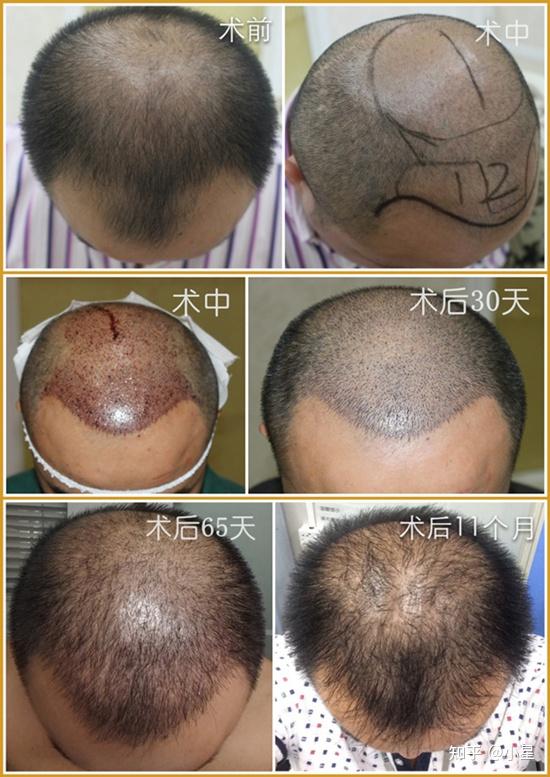 植发一个毛囊多少钱