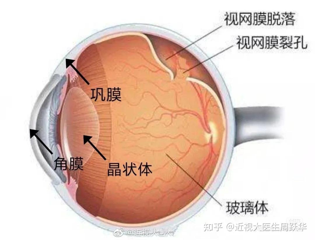 近视手术会导致视网膜脱落吗