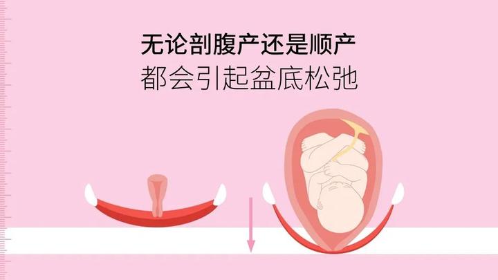10个顺产，8个会阴撕裂！减轻裂伤的方法你知道吗？ - 知乎