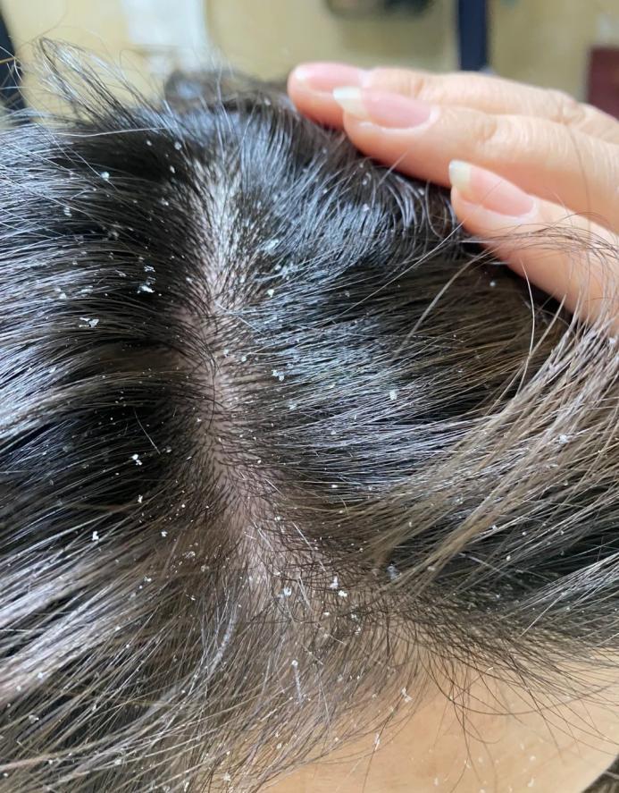 为什么洗完就有头皮屑?是跟洗头频率有关吗?