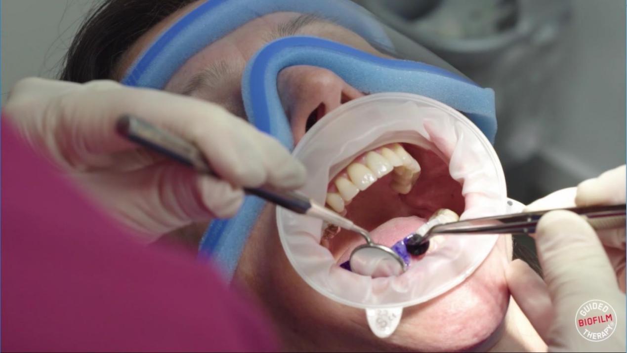 选择正确的洗牙方式才能让你笑到最后