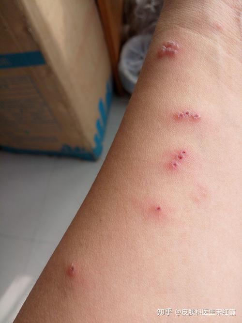 疤痕体质被蚊子咬图片图片