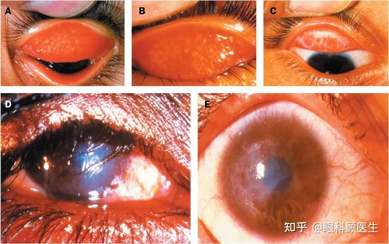 沙眼是由沙眼衣原体感染所致,是一种慢性传染性结膜角膜炎.