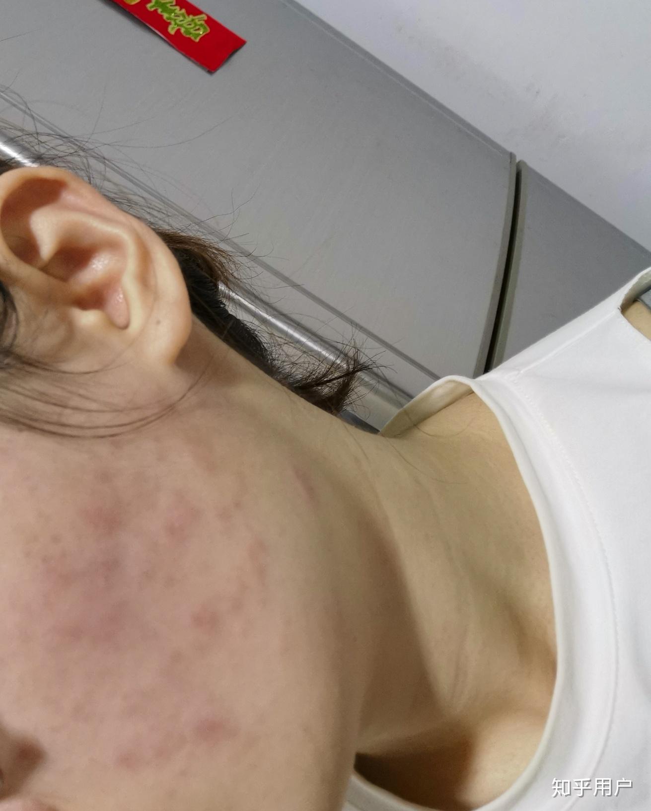 关注问题 67 写回答 登录/注册 过敏 过敏症状 皮试过敏有什么酚Ζ