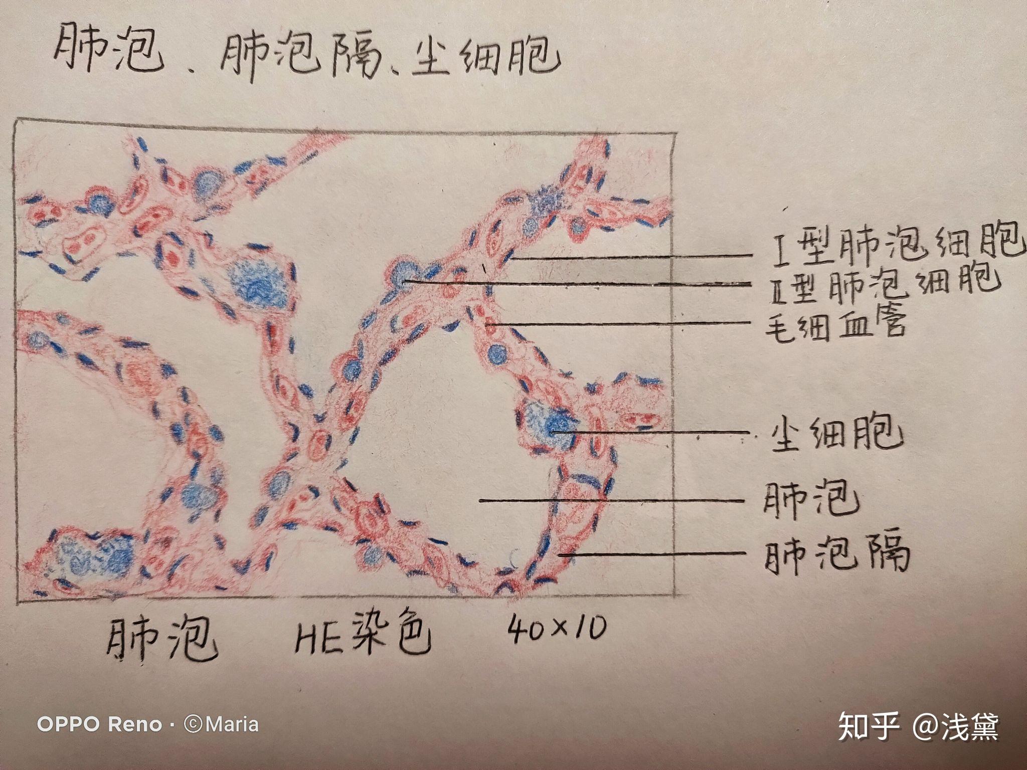 肺结核的红蓝铅笔图图片