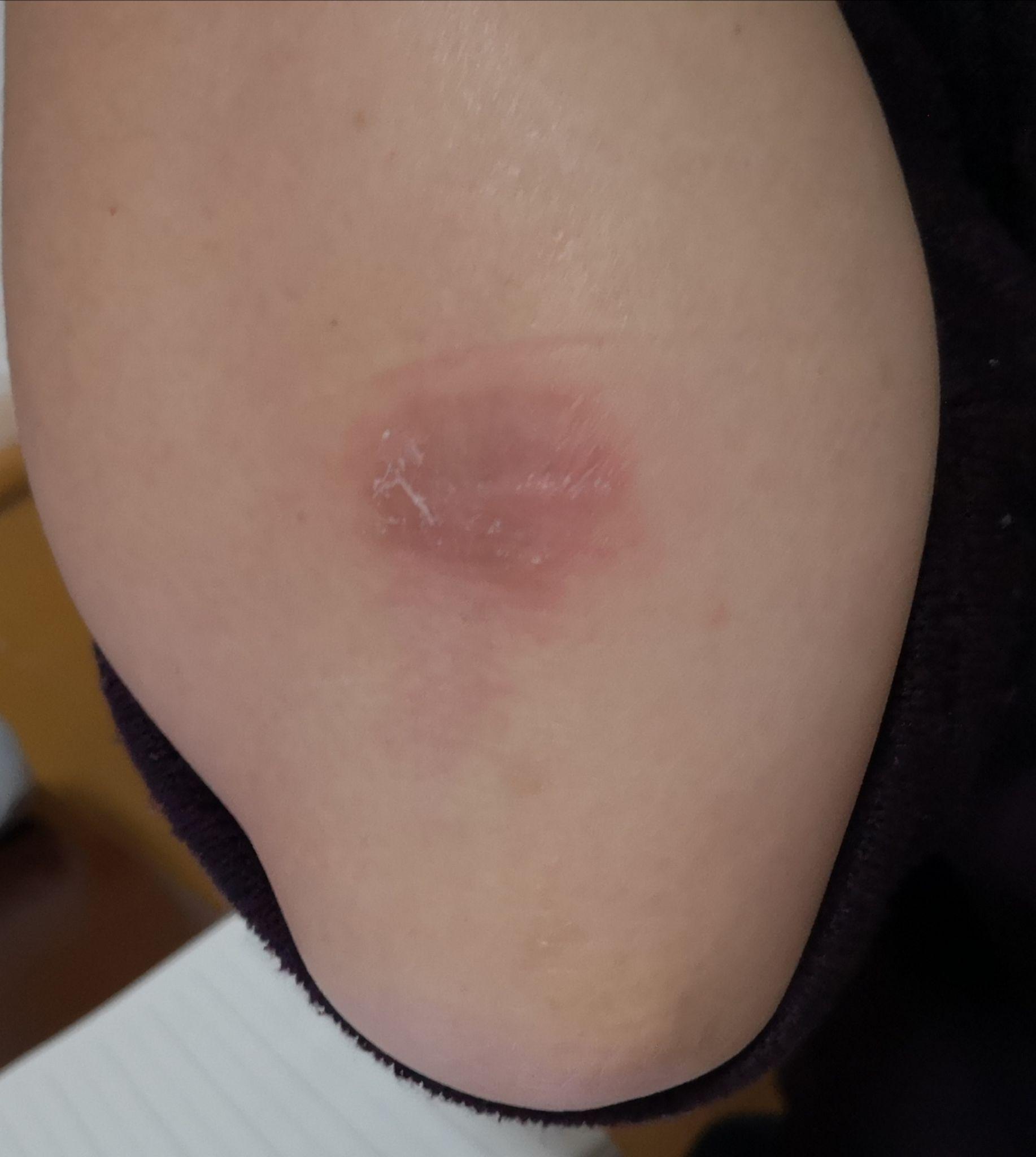 你身边有什么奇怪的病?听说过或经历过特应性皮炎的故事吗?