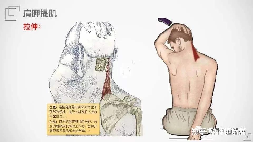 再看肩胛提肌损伤