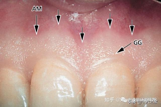 在这里我们要提的一点是:角化粘膜有明显的上皮钉突和结缔组织乳头,而