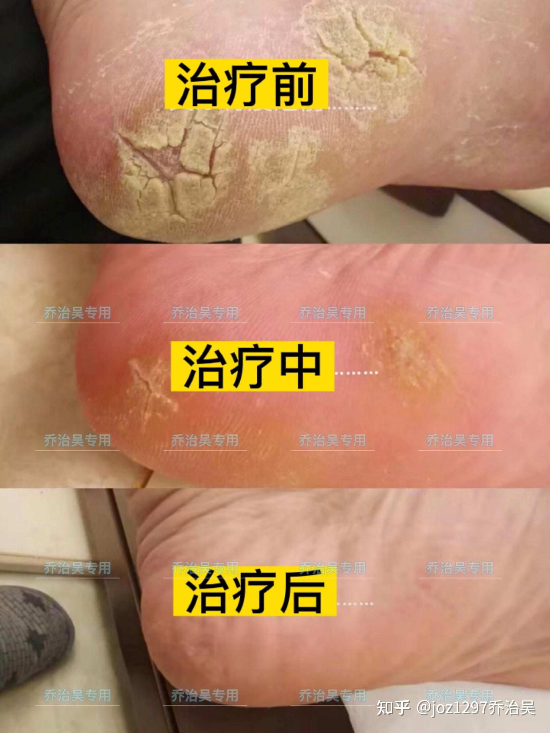 生活中治疗脚气的方法有哪些