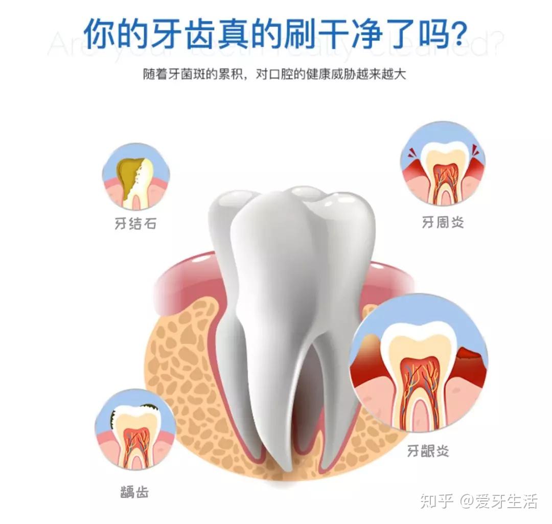 如何预防儿童蛀牙的产生？_深圳爱康健口腔医院(官网)