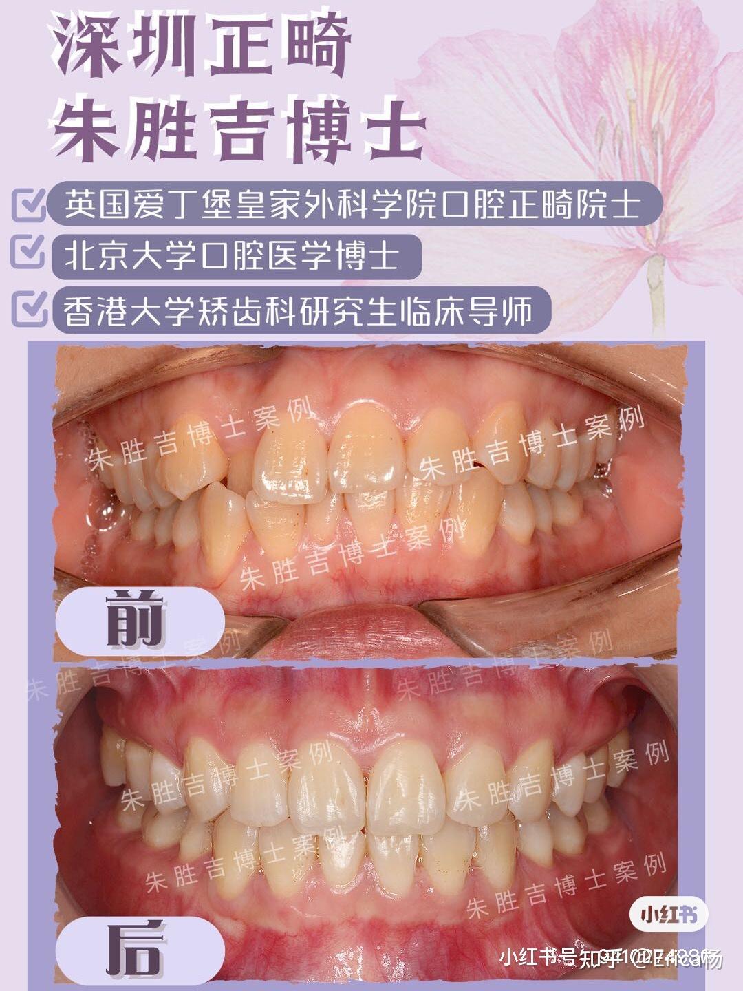 深圳牙齒矯正絕美變化上頜骨性前突內收