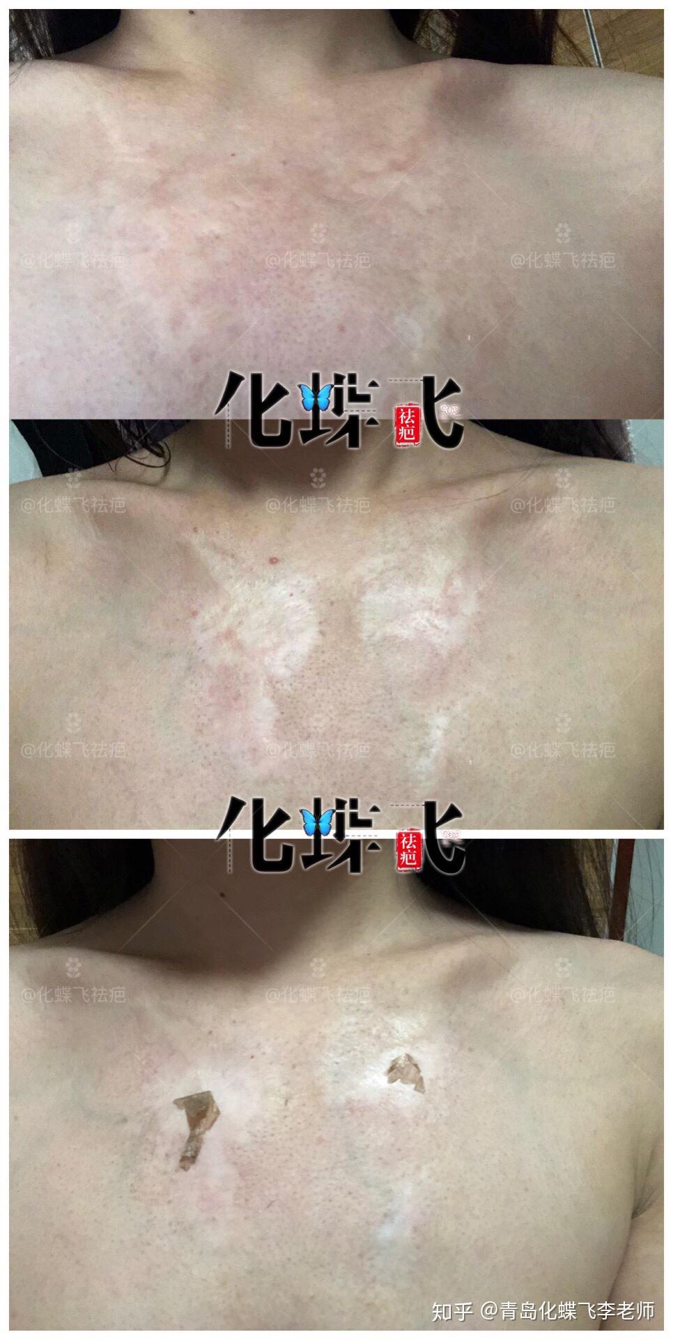 20多年的烫伤疤痕修复效果对比