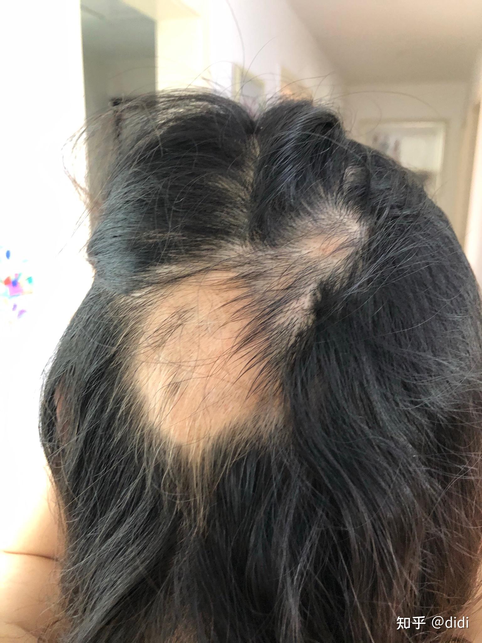 请问各位得过严重斑秃的乎友比如全秃和普秃这种最后是怎样痊愈的呢