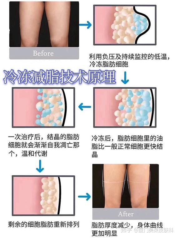 酷塑冷冻减脂针对的是皮下脂肪层,治疗时采用真空负压将局部脂肪吸入