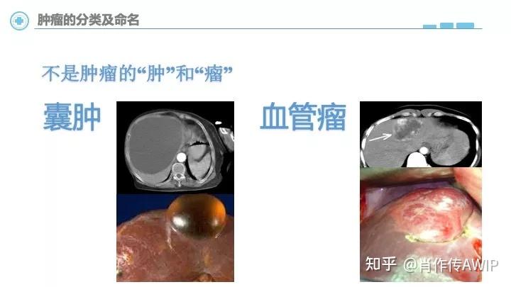 中国医师协会癌症的真相为什么会长肿瘤恶性肿瘤常见表现检测与治疗
