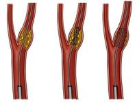 食道癌吞咽困难要不要装支架让指南告诉你