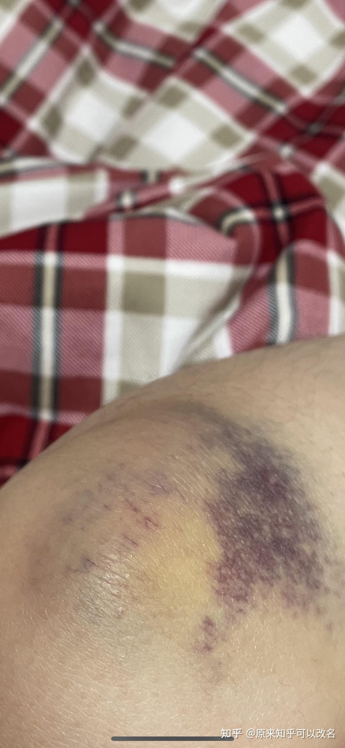 腿碰的淤青发紫图片图片