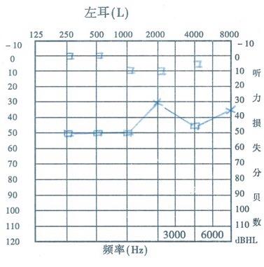 “老年人聆通听力专栏”——快速看懂听力报告（2） - 知乎