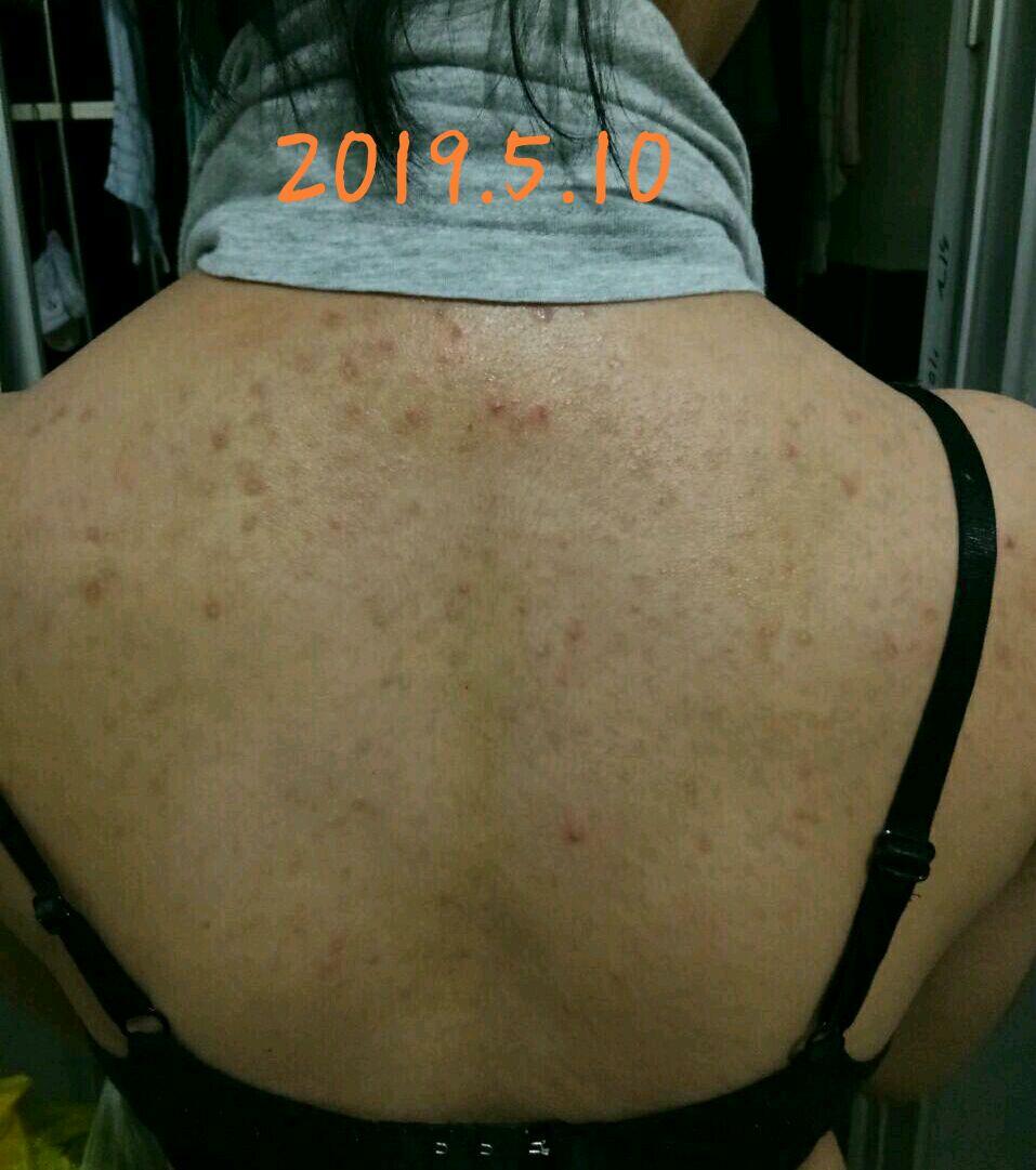 背后长痘并有红色痘印怎么消?背部还可以用去角质膏吗?
