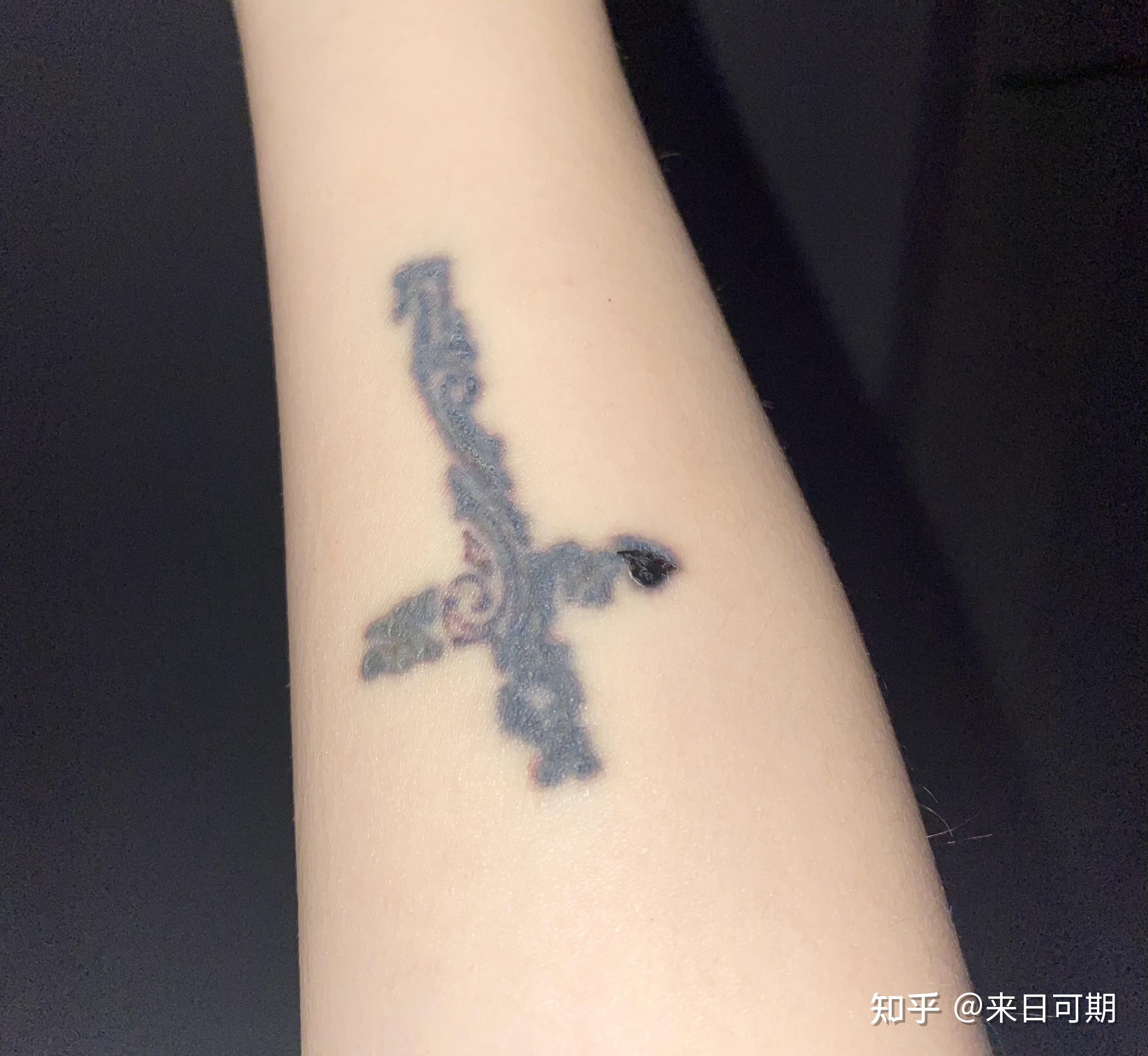 11傍晚喷百多邦  冰块冰敷5.12中午  起泡  增生明显5.