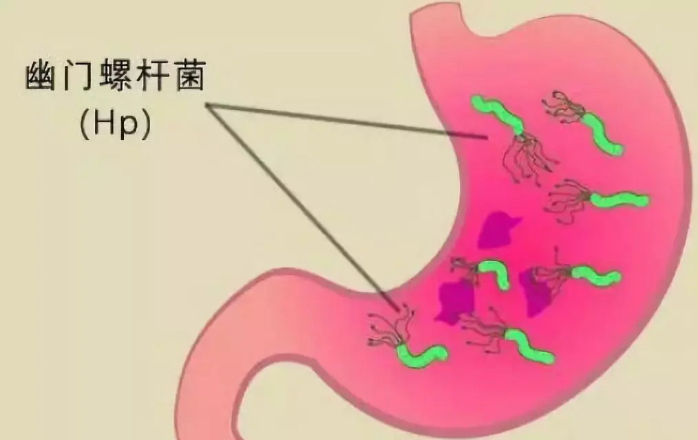 hp感染是目前最明确的胃癌发生危险因素.