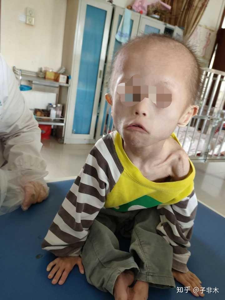 唐氏综合征的孩子不应该出生吗