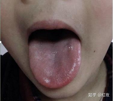 口臭是什么原因造成的怎么去除 v2-8ab01ab45877b160004f3347d27979a8_b.jpg