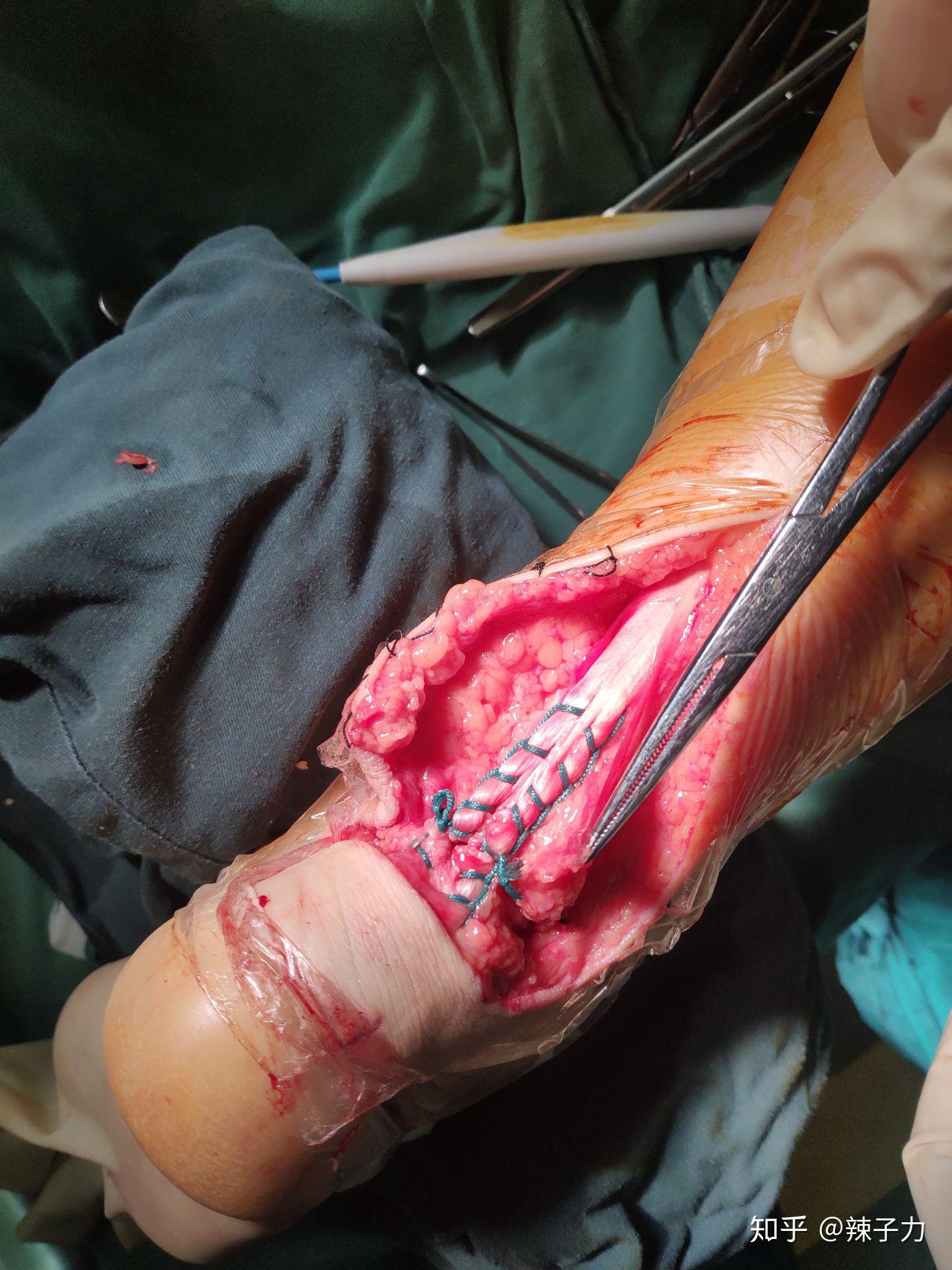 跟腱断裂之后,手术是如何接上的呢? - 知乎