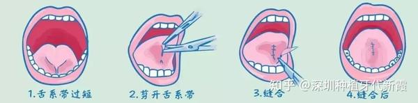 什么是舌系带短？这会有什么影响吗？该怎么判断舌系带短？孩子舌系带过短一定要剪掉吗？何时手术最好呢？ - 知乎