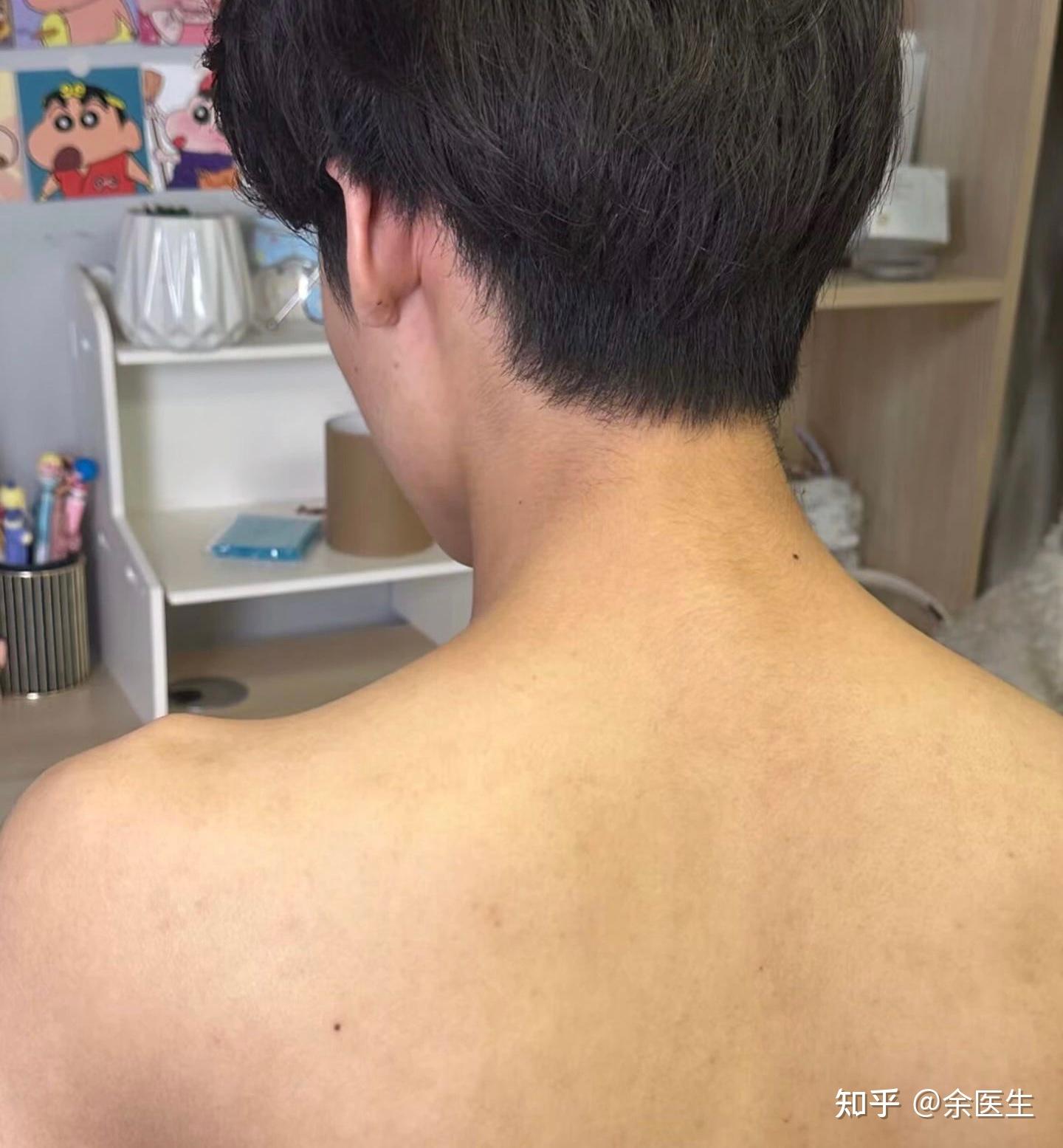 为什么医生建议男生干燥起皮,背痘严重,一定要调节“水油平衡”? - 知乎