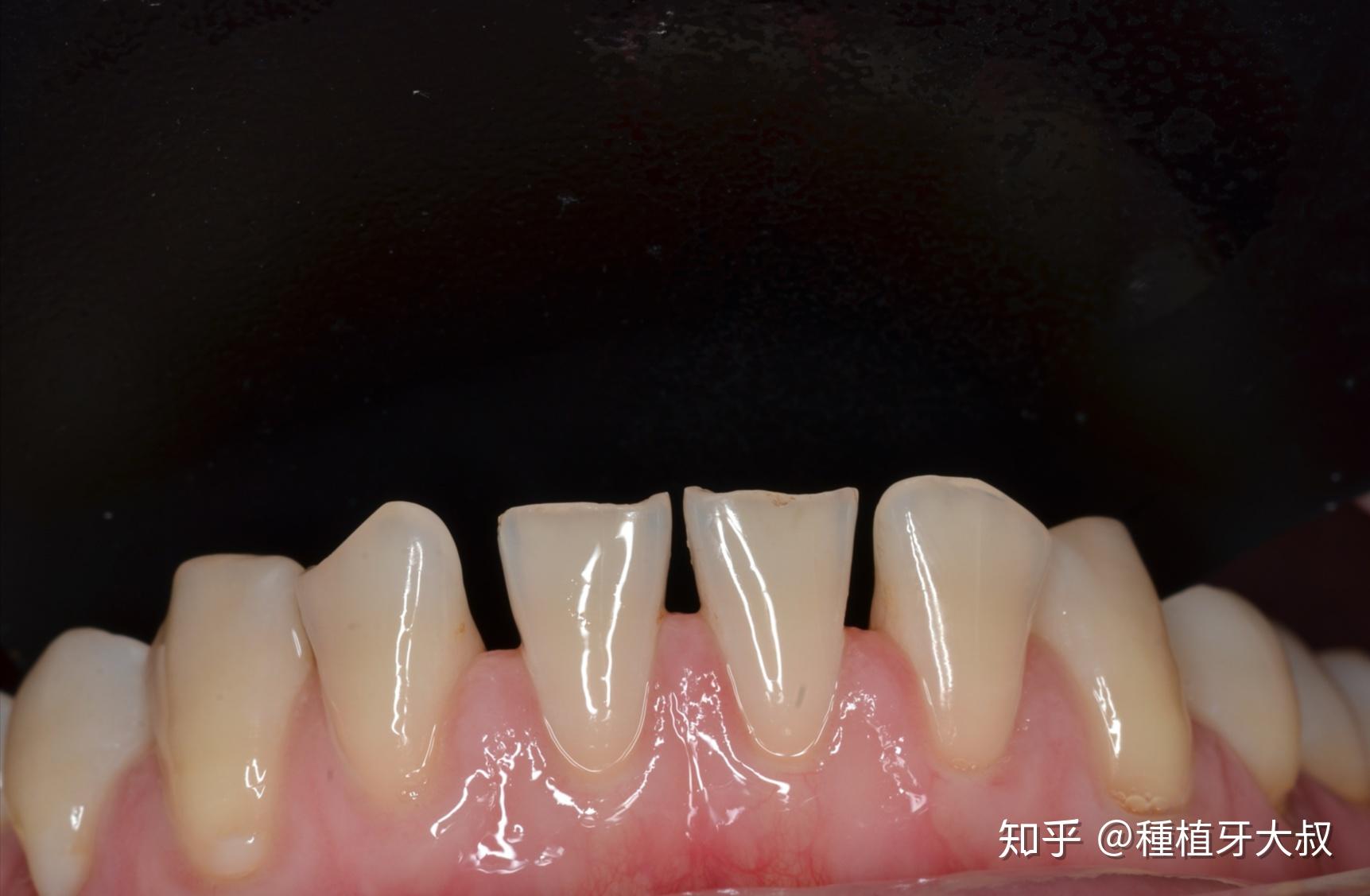 门牙牙缝大,那些做过牙冠和牙贴面的过来聊聊做后的感受呗? - 知乎