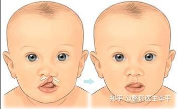 兔唇整形是怎么回事?兔唇和吃兔肉有关吗? - 知乎