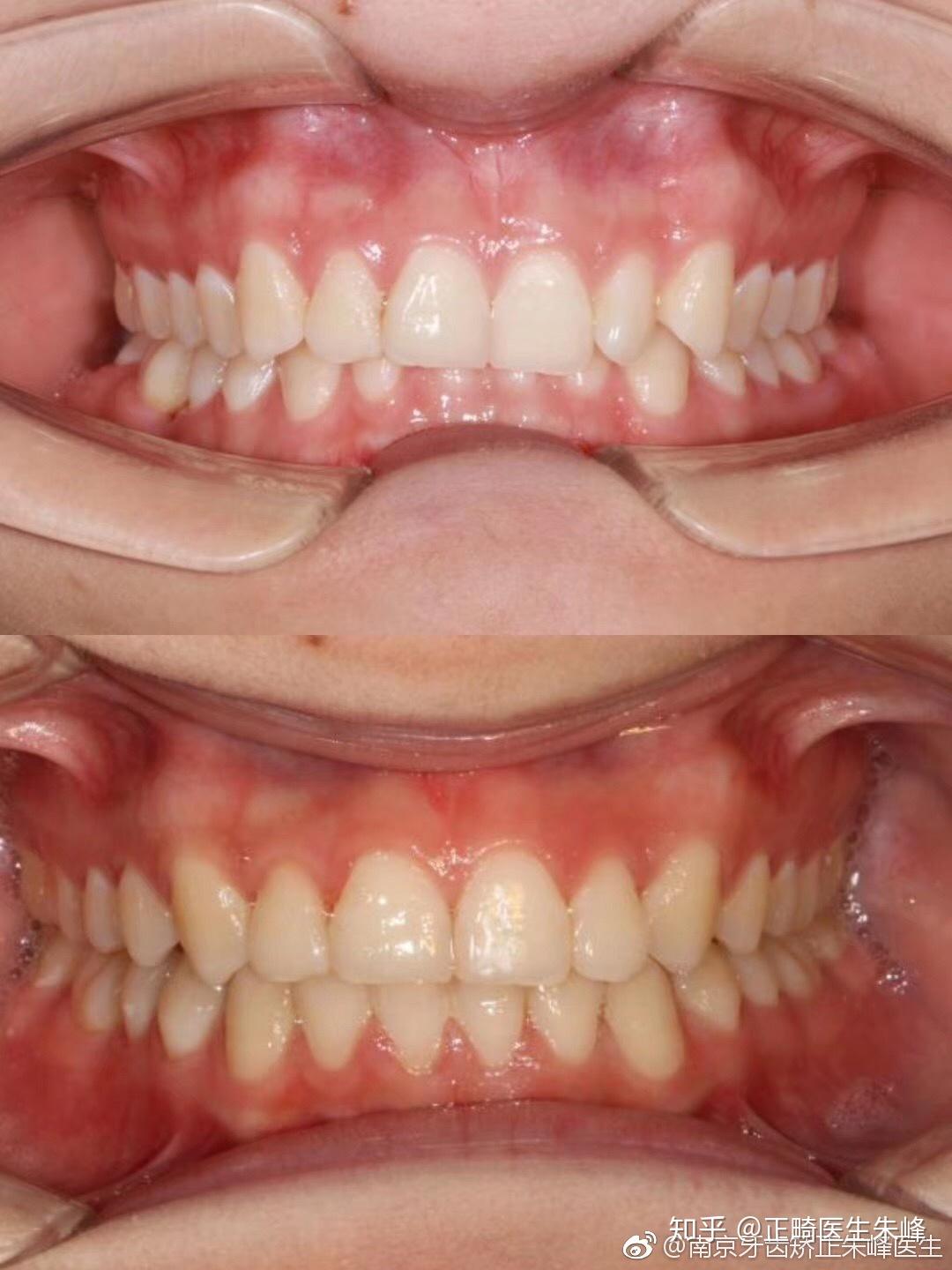 深覆合vs深覆盖