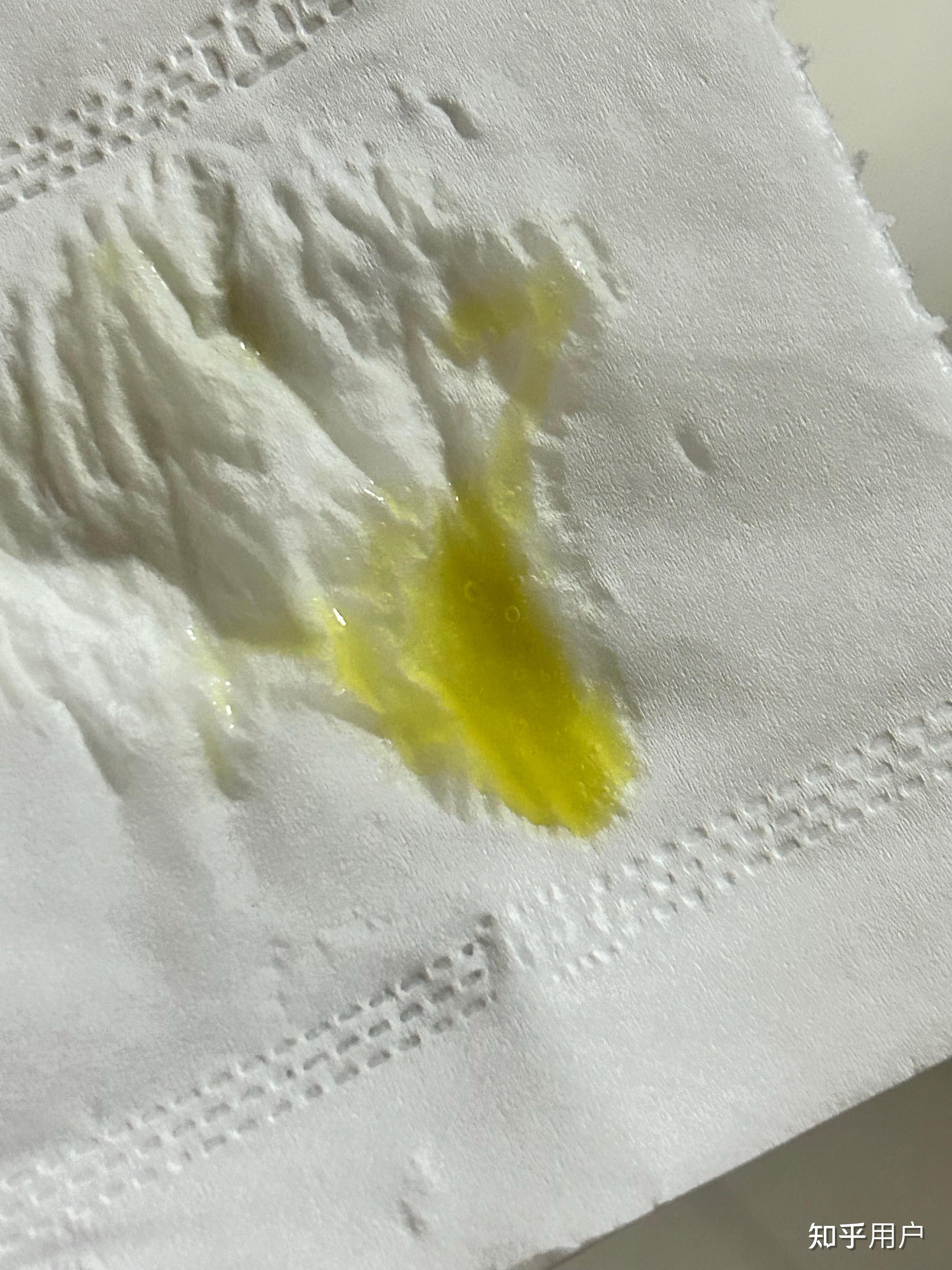 感冒了为什么现在的鼻涕是黄色的,很艳很艳的亮黄色,和颜料的颜色一样而且不是浓的,是很水的那种? - 知乎