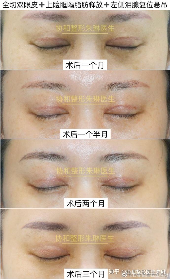 今日案例全切双眼皮77上睑眶隔脂肪释放77左侧泪腺复位悬吊