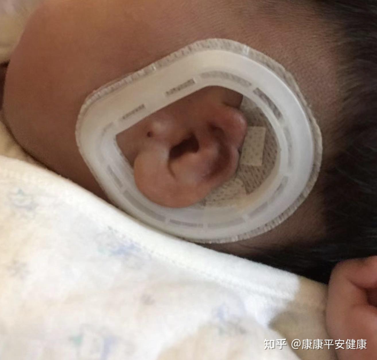 四维查出小耳畸形,还会留下吗?