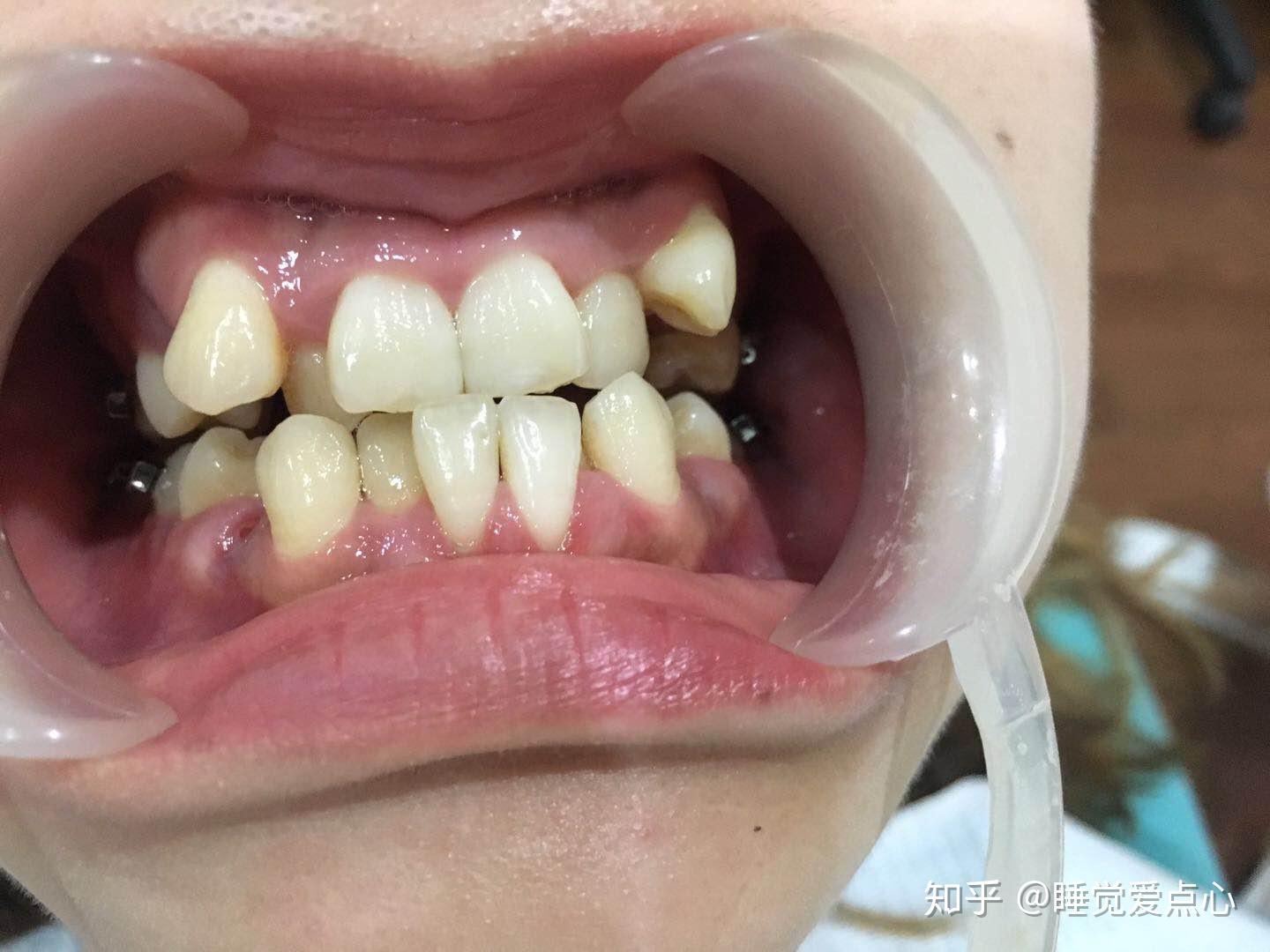 一个人的牙能乱到什么地步