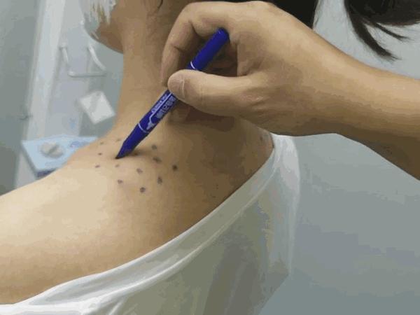 肉毒素瘦肩瘦胳膊亲测| 从肌肉的角度打造直角肩