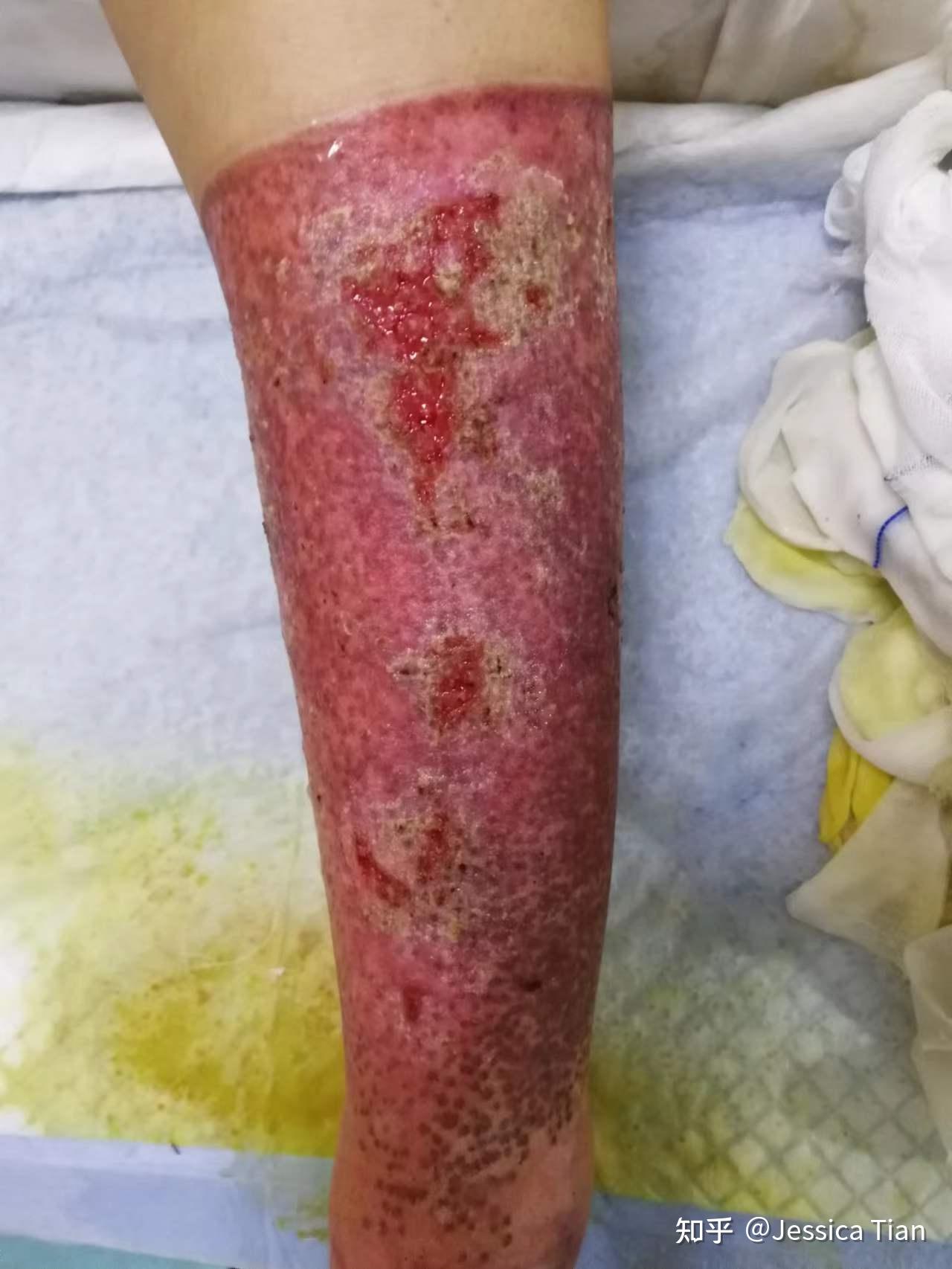 烧伤康复过程(重二度和轻三度,烧伤面积30%)