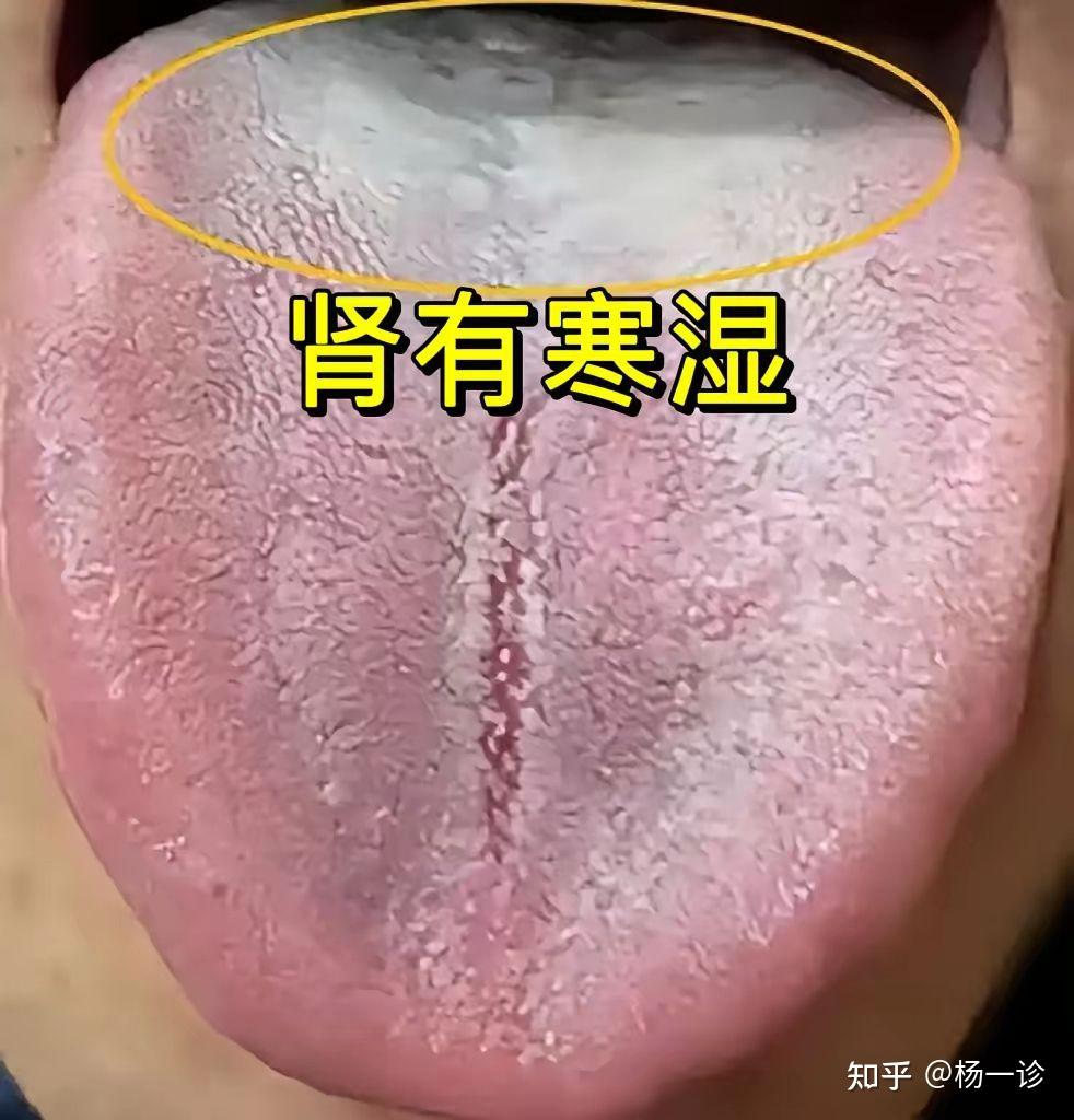 今日分享6种肾虚舌象,及典型表现,大家可以对照自身看一下自己是哪种情况 - 知乎