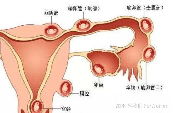 宫外孕的症状和成因 知乎