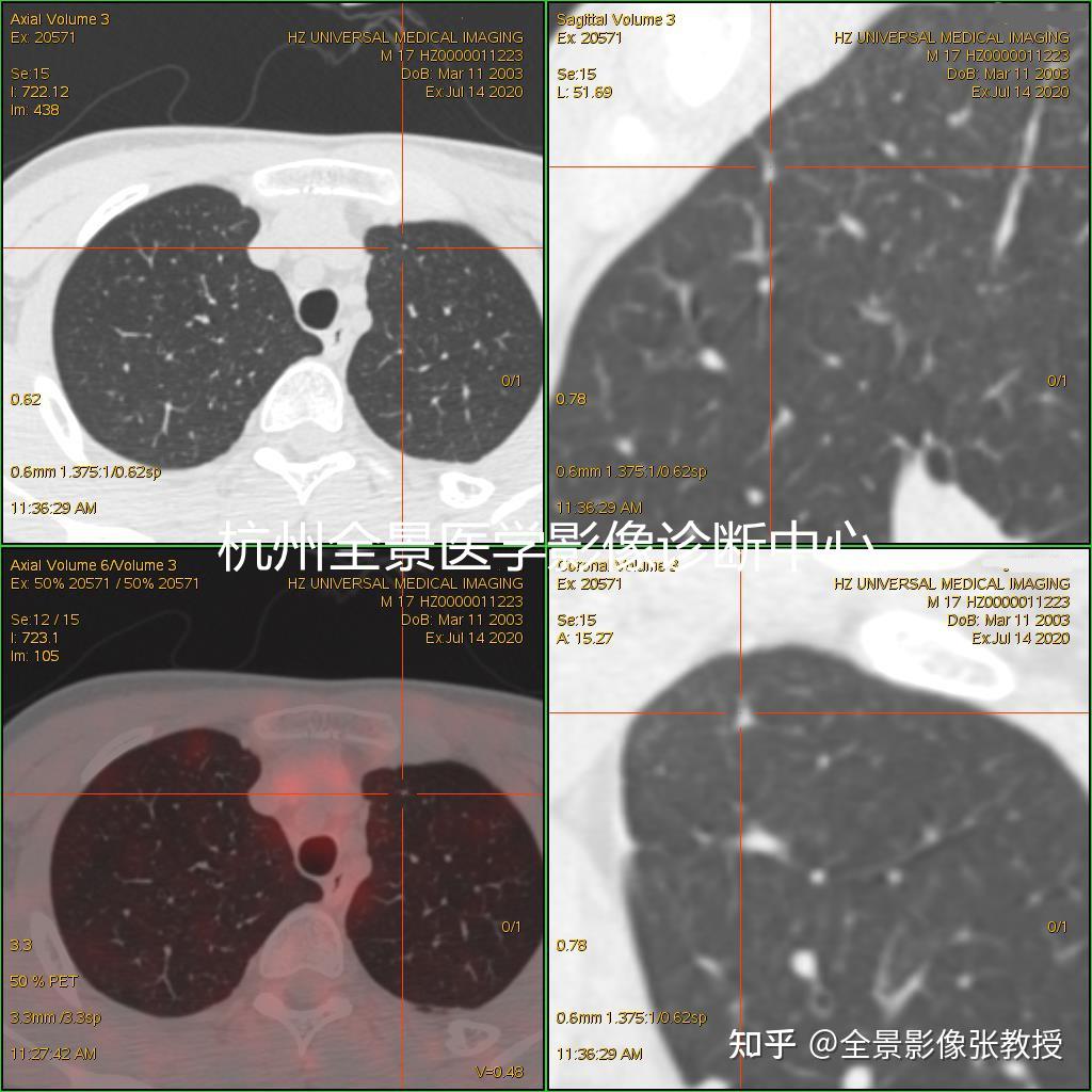 浅谈如何解读PET/CT报告中SUV值高低？ - 知乎