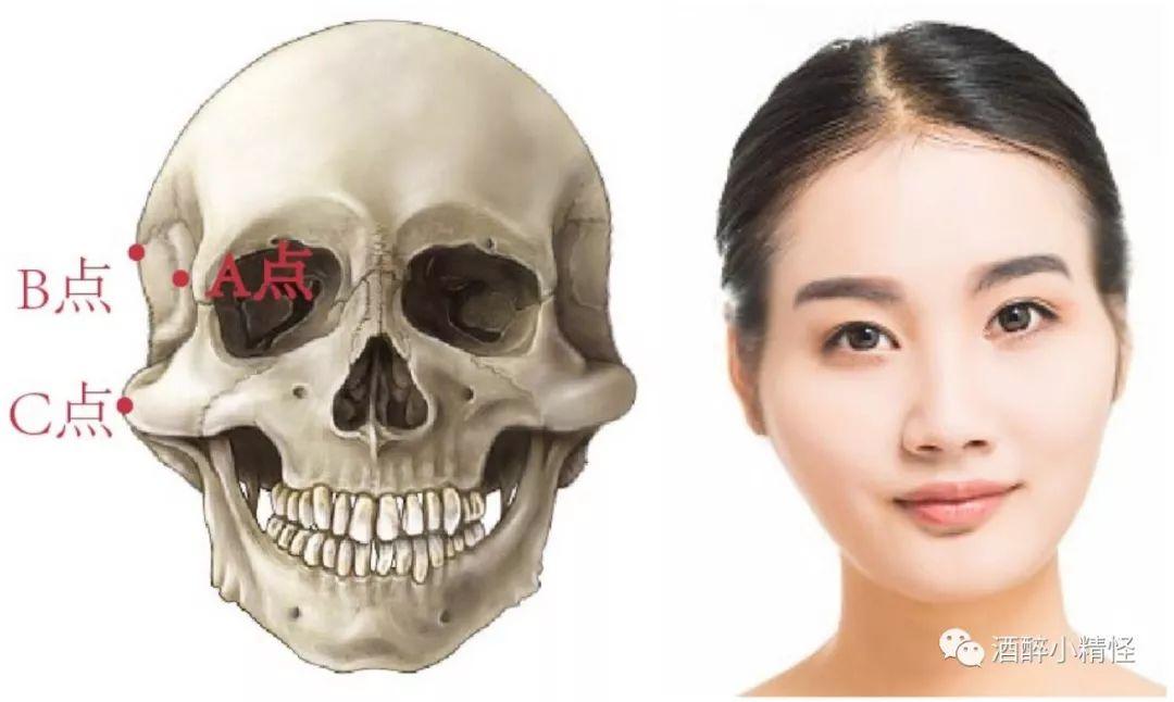 颧骨整形下| 教你辨认自己到底需要填充太阳穴还是颧骨内推&奚梦瑶的到底做颧弓内推了吗 - 知乎